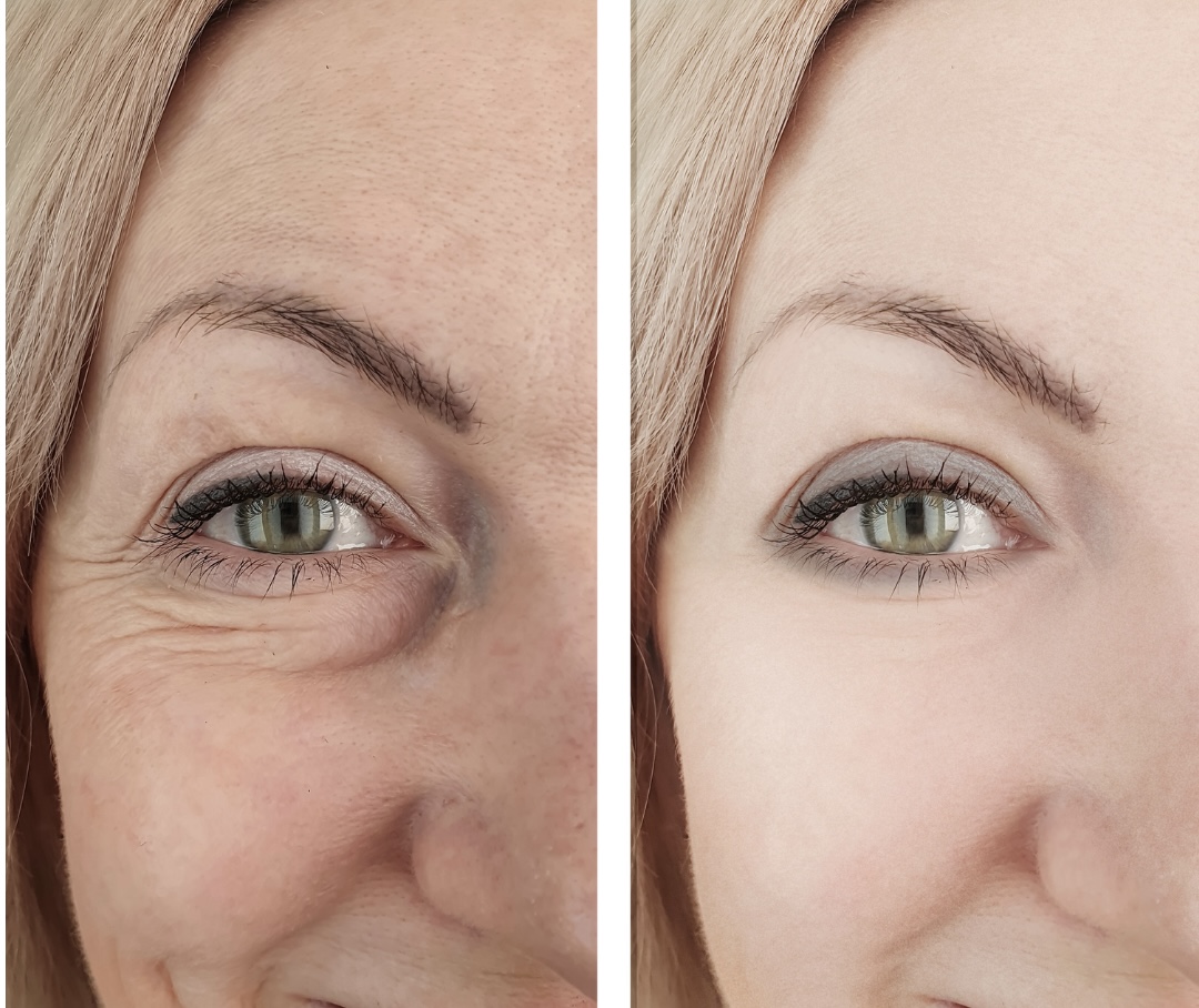 PRF before and after — Crow's feet & under-eye crepiness