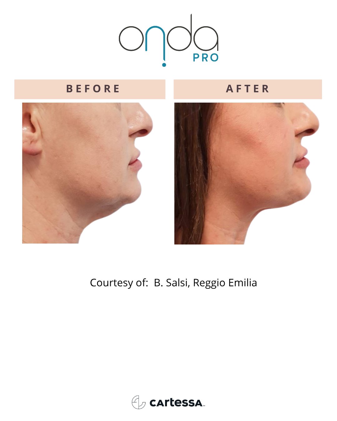 ONDA Pro before and after — Jawline definition
