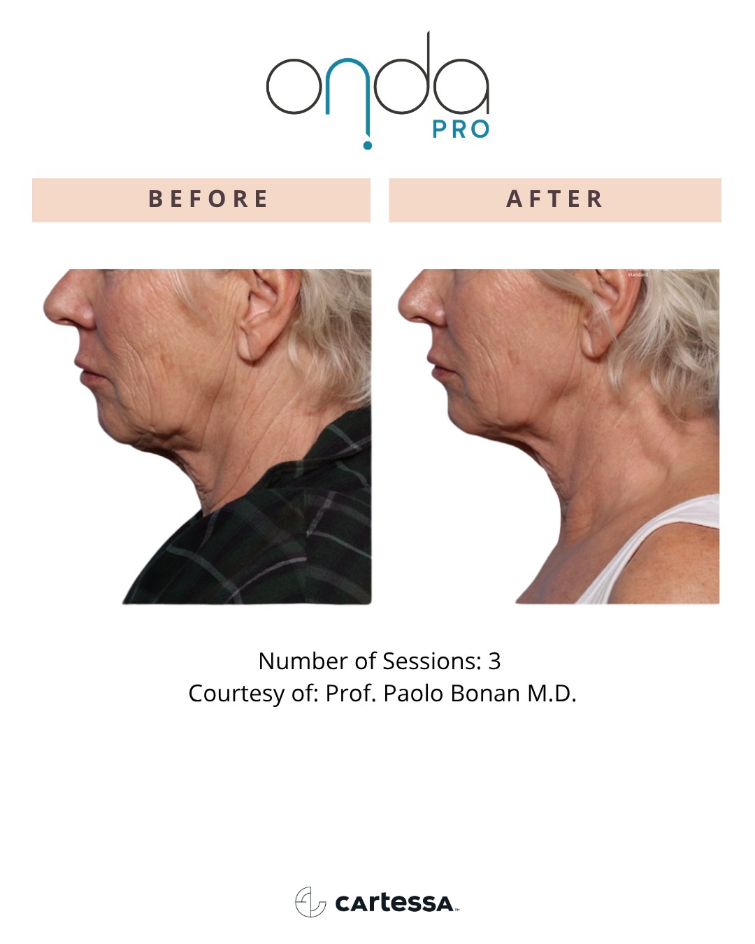 ONDA Pro before and after — Neck & jawline