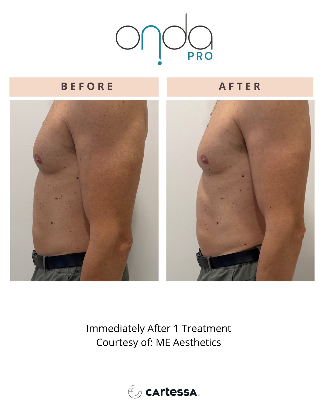 ONDA Pro before and after — Flanks