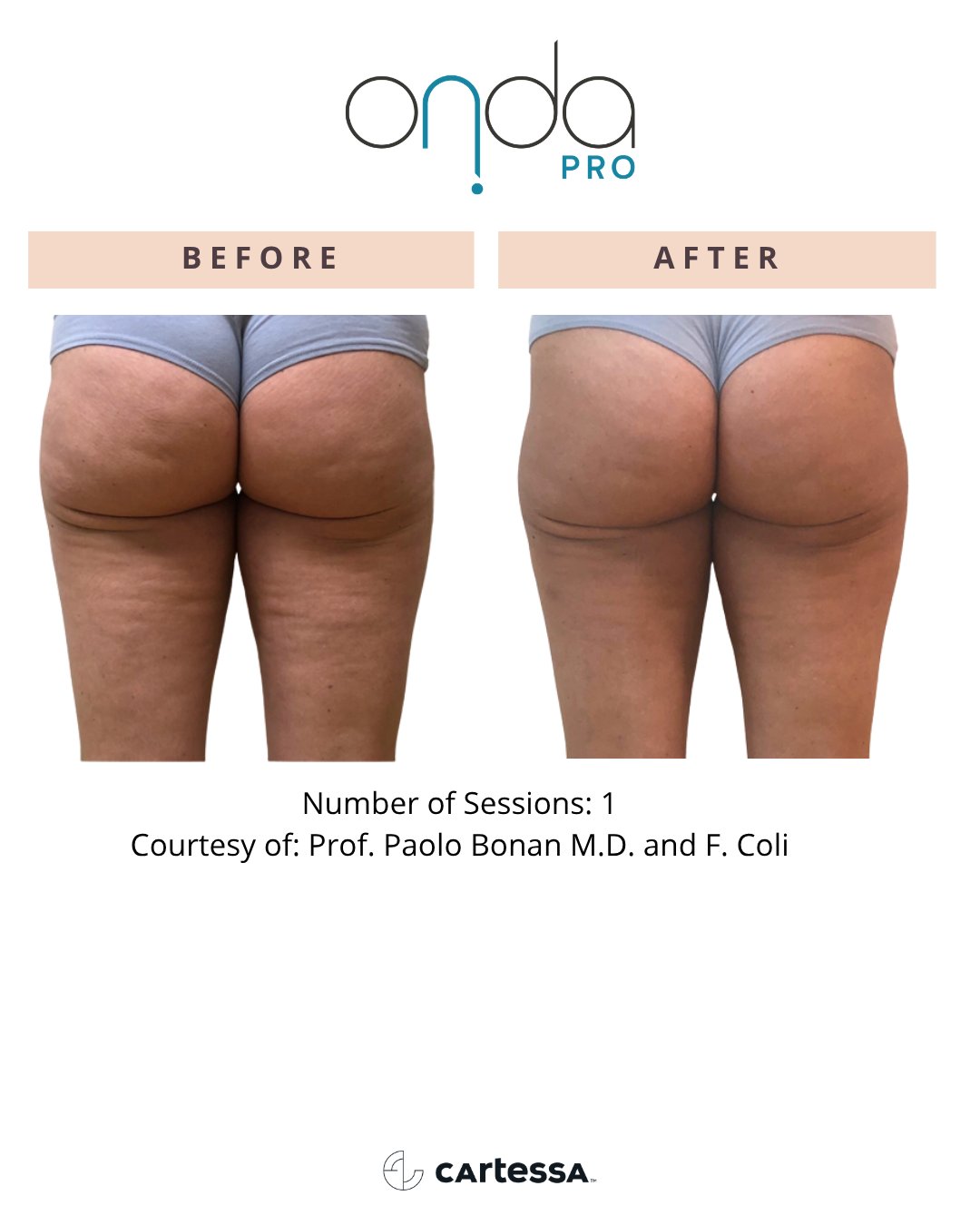 ONDA Pro before and after — Thighs & glutes
