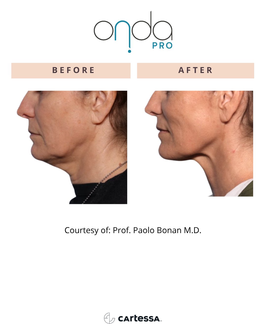 ONDA Pro before and after — Neck & jawline