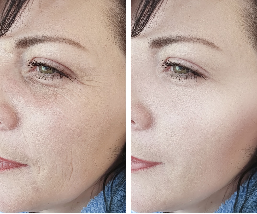 PRF before and after — Cheek & under-eye texture