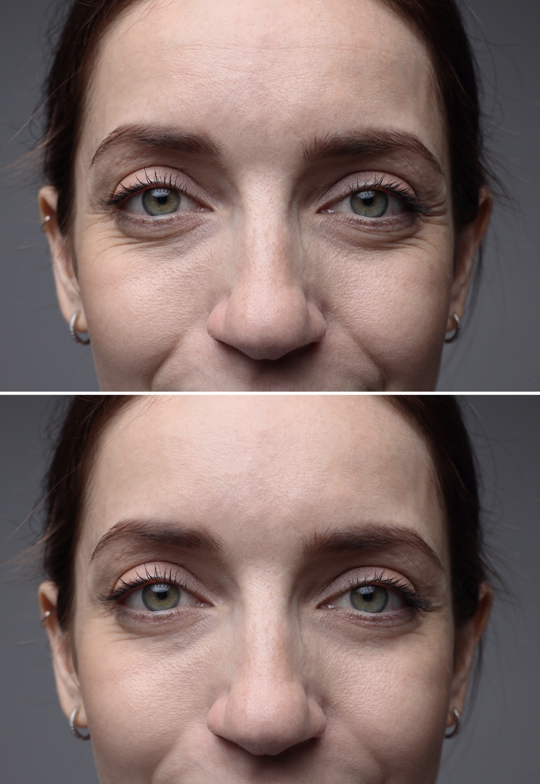 PRF before and after — Under-eye hollows
