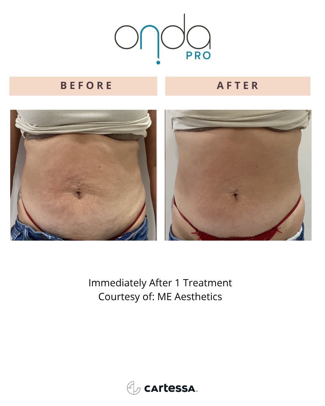 ONDA Pro before and after — Abdomen